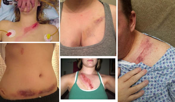 lesioni-cintura-auto_1